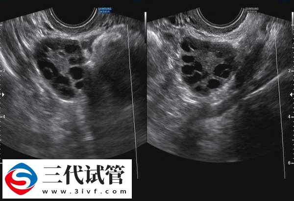 三代试管7个卵泡够用不(图1)