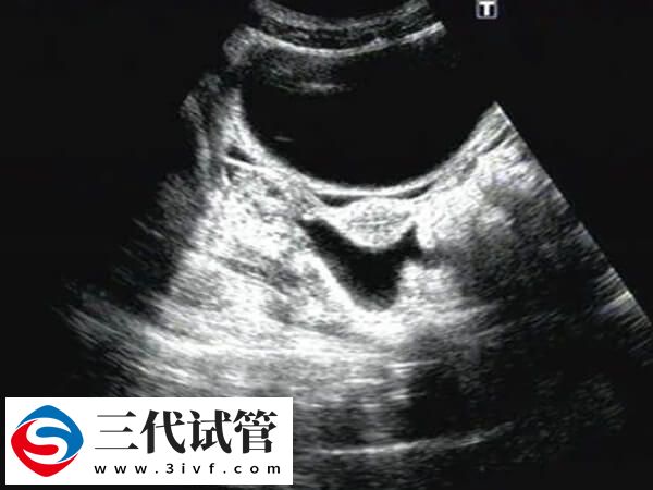 鲜胚移植后宫腔积液多久能吸收(图1) 鲜胚移植后宫腔积液多久能吸收(图1)