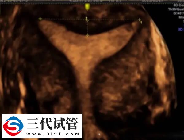 鲜胚移植后宫腔积液多久能吸收(图2) 鲜胚移植后宫腔积液多久能吸收(图2)