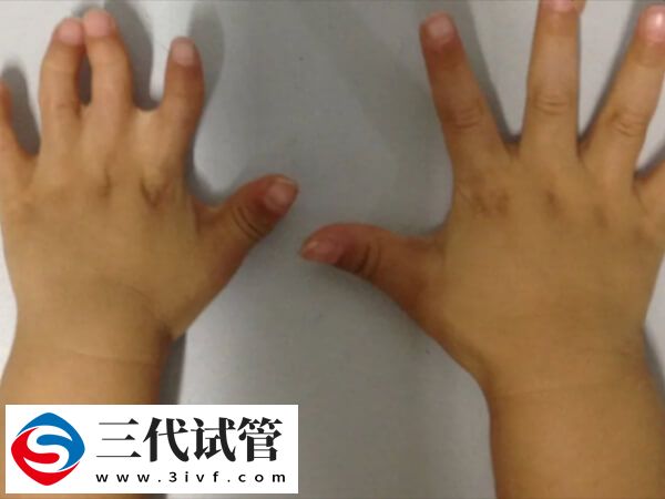 apert综合征能做三代试管要二胎吗？(图1)