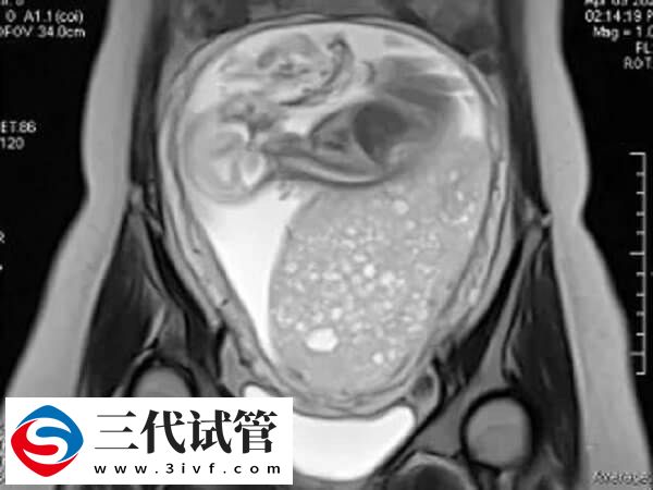 试管婴儿促排期间做b超的原因是什么(图1) 试管婴儿促排期间做b超的原因是什么(图1)