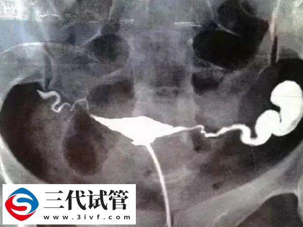 双侧输卵管梗阻怎么治疗(图1)