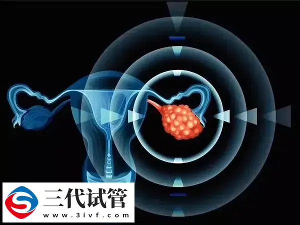多囊卵巢适合什么促排方案(图1) 多囊卵巢适合什么促排方案(图1)